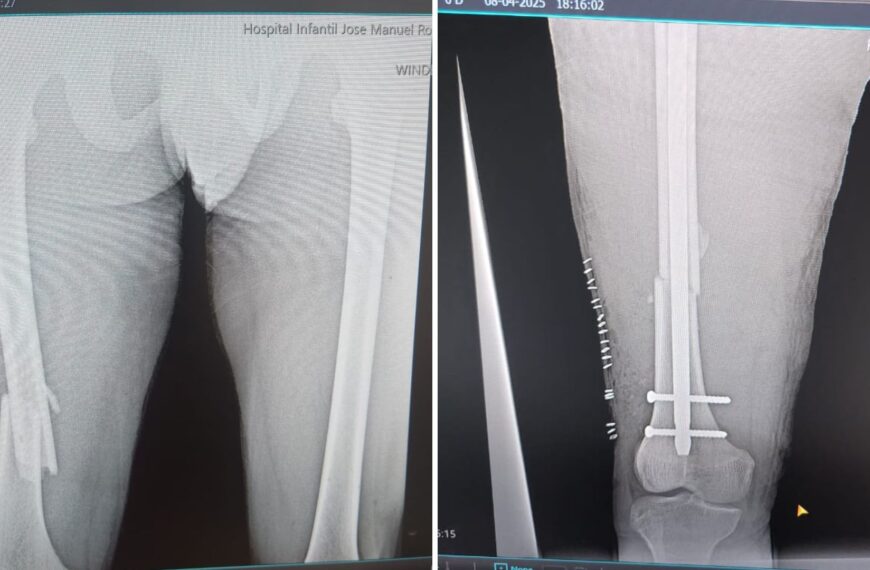 Santo Domingo. – El Hospital Infantil Dr. José Manuel Rodríguez Jimenes alcanzó un nuevo hito con la realización de su primera cirugía en el área de Ortopedia, un procedimiento de reducción abierta con fijación interna mediante material de osteosíntesis de fémur, efectuado con éxito por el equipo de especialistas del centro. Este logro marca el inicio oficial de los servicios quirúrgicos ortopédicos en el hospital y reafirma el compromiso de la institución de ofrecer atención médica de excelencia, respaldada por tecnología avanzada y profesionales altamente capacitados. La dirección del hospital destacó que este paso consolida la misión de brindar un cuidado integral y seguro a los pacientes pediátricos, garantizando su bienestar y una recuperación adecuada.