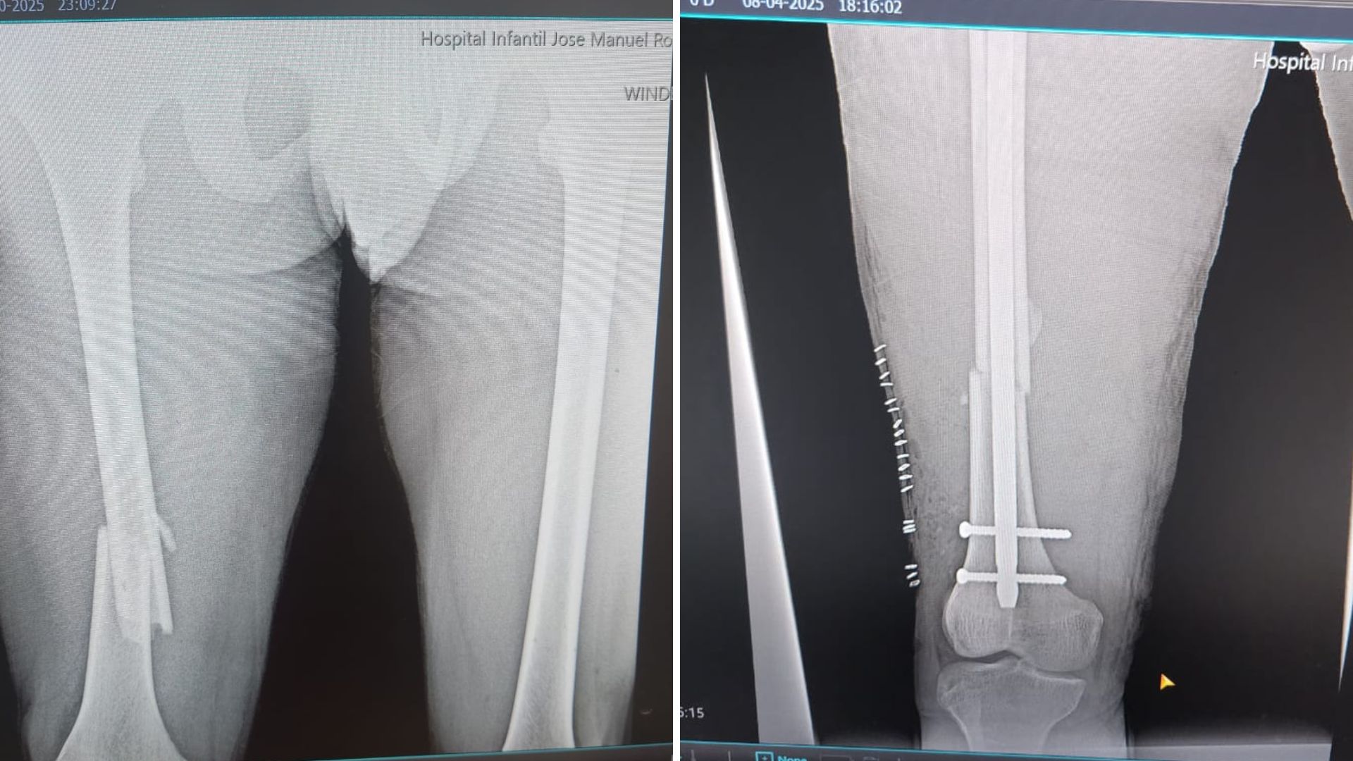 Santo Domingo. – El Hospital Infantil Dr. José Manuel Rodríguez Jimenes alcanzó un nuevo hito con la realización de su primera cirugía en el área de Ortopedia, un procedimiento de reducción abierta con fijación interna mediante material de osteosíntesis de fémur, efectuado con éxito por el equipo de especialistas del centro. Este logro marca el inicio oficial de los servicios quirúrgicos ortopédicos en el hospital y reafirma el compromiso de la institución de ofrecer atención médica de excelencia, respaldada por tecnología avanzada y profesionales altamente capacitados. La dirección del hospital destacó que este paso consolida la misión de brindar un cuidado integral y seguro a los pacientes pediátricos, garantizando su bienestar y una recuperación adecuada.